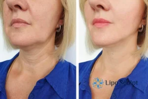 Double chin before and after Hi-Fu treatment 4 Book your double chin treatment Waltham Forest today! We are here to help!