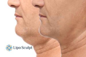 Double chin before and after Hi-Fu treatment 2 Double chin treatment Waltham Forest from Lipo Sculpt - feel more confident today!