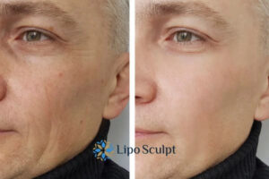 How to Fight Aging Symptoms 3 Fight Aging Symptoms Waltham Forest With HIFU and Morpheus8 Today!