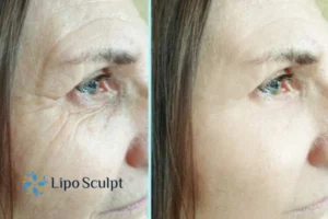 How to Fight Aging Symptoms 2 Do you want to Fight Aging Symptoms Waltham Forest? Contact Lipo Sculpt today!