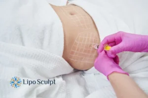 Are The Results From Aqualyx Permanent? 1 Do you want to know how long Aqualyx Waltham Forest results last?