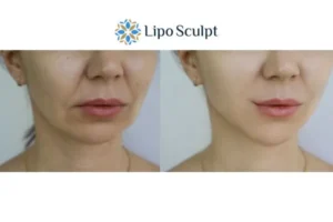 Explaining Total Skin Tightening Treatment And What It Can Do For You 2 Do you want to boost your self confidence? Give Morpheus8 Waltham Forest a try today!