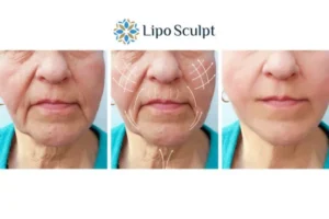 Explaining Total Skin Tightening Treatment And What It Can Do For You 3 Boost your confidence with Morpheus8 Waltham Forest call our team today!