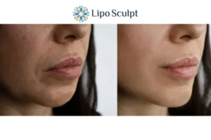 Explaining Total Skin Tightening Treatment And What It Can Do For You 4 Morpheus8 Waltham Forest the best results - call our team today!