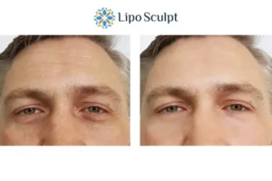 Explaining Total Skin Tightening Treatment And What It Can Do For You 6 Morpheus8 Waltham Forest book in today to find out more!