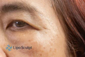 Cryopen: The Revolutionary Treatment for Age Spots Unveiled 2 Are age spots Waltham Forest giving you low self esteem? Contact us today!