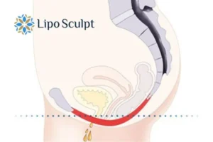 Pelvic Floor Chair Therapy 1 Pelvic Floor Chair Therapy Waltham Forest to treat incontinence.
