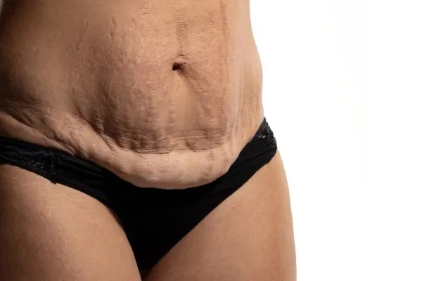 Lost the Weight but Not the Loose Skin? 1 image of womans stomach after weight loss showing loose skin Waltham Forest